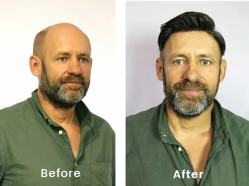 Best Hair Patch in Agra Benefits of Getting the Best Hair Patch in Agra