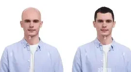 Top Hair Solution Services for Baldness & Thinning Hair