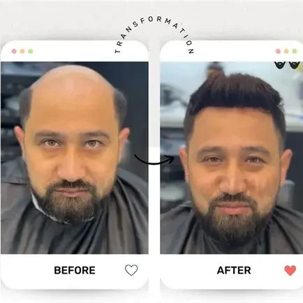 Advanced Non-Surgical Hair Replacement
