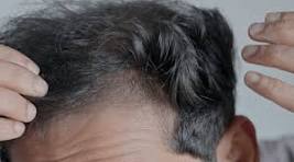 About Say Goodbye to Hair Loss Forever
