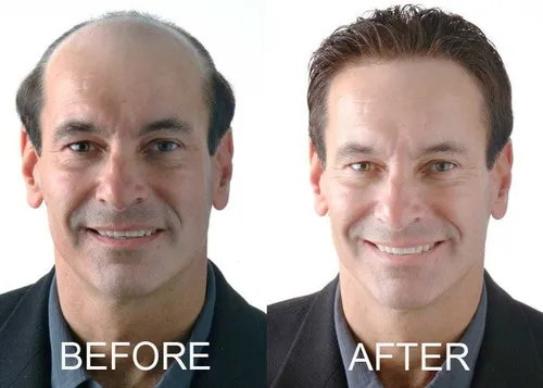 Benefits of Getting the Best Hair Patch in Agra