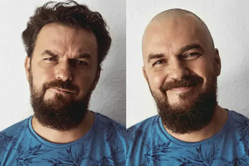 Best Hair Patch in Agra
