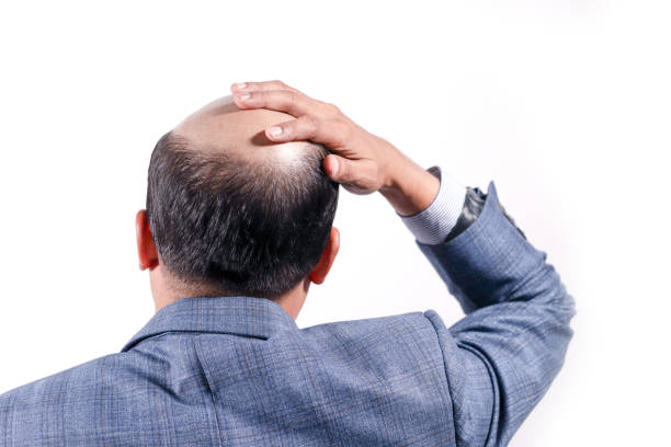 About bald businessman with his head on scalp view from behind with white background